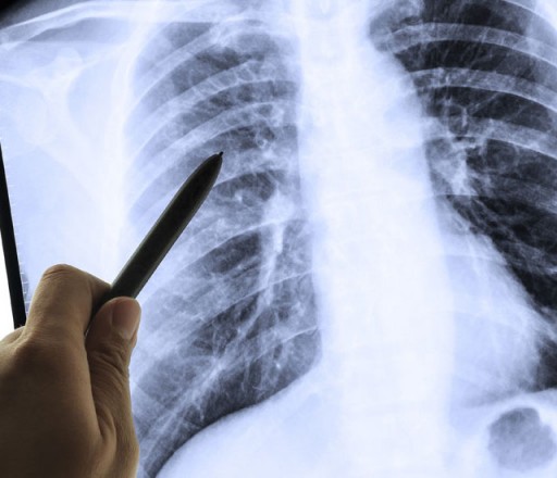 Lung Scan Lung Scan